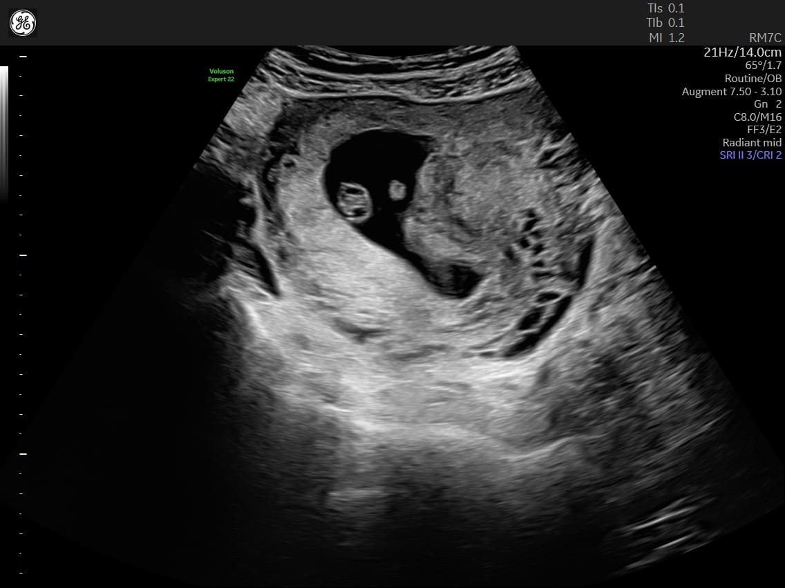 Early Pregnancy Ultrasound Scan